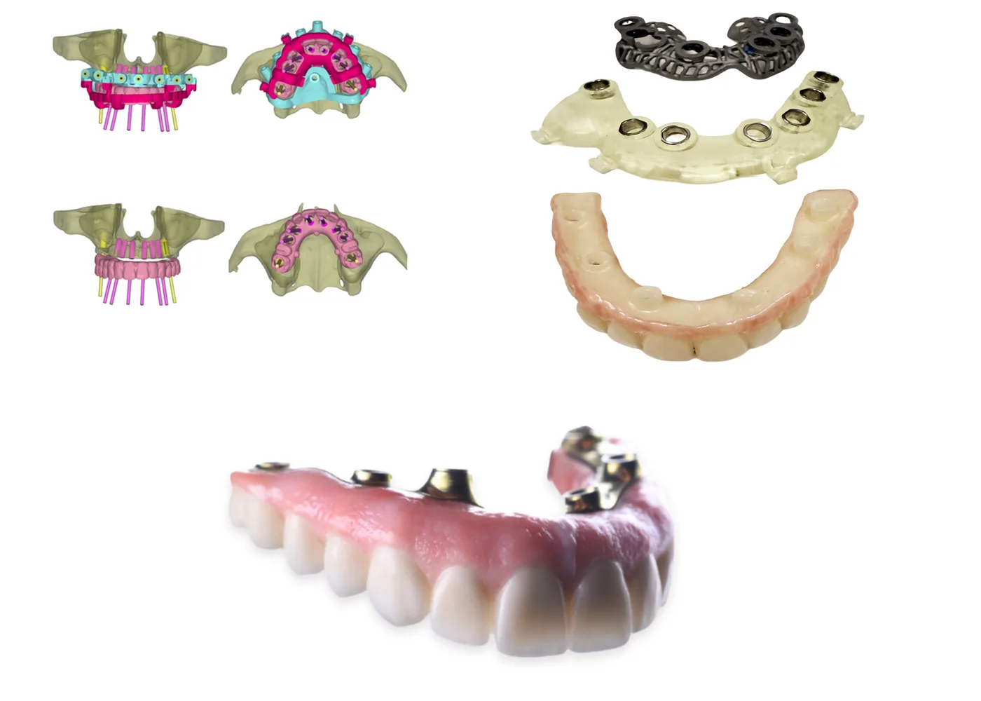 manufactured surgical guides for full-arch implant planning at Viva Smile, Granada Hills.