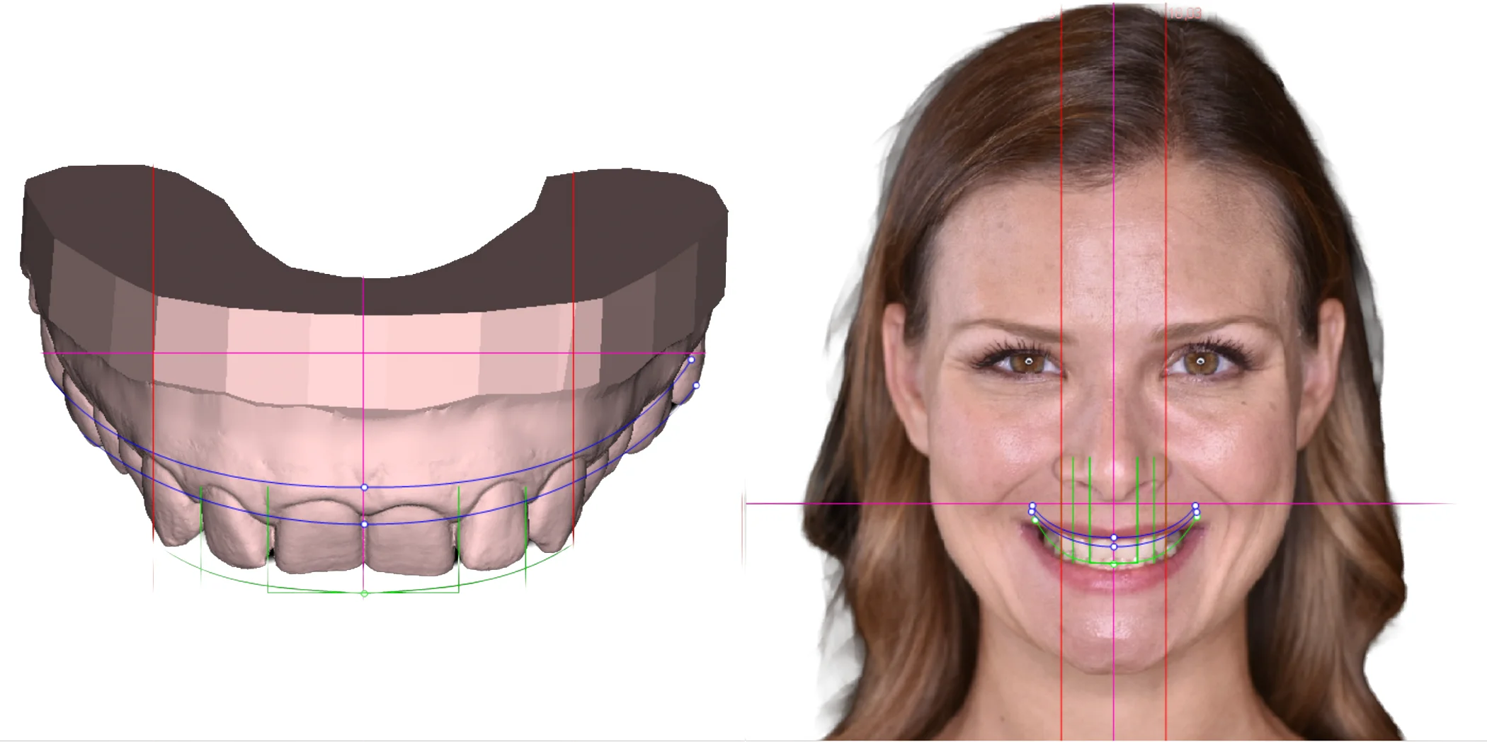 Designing patient smile with DSD planing center.