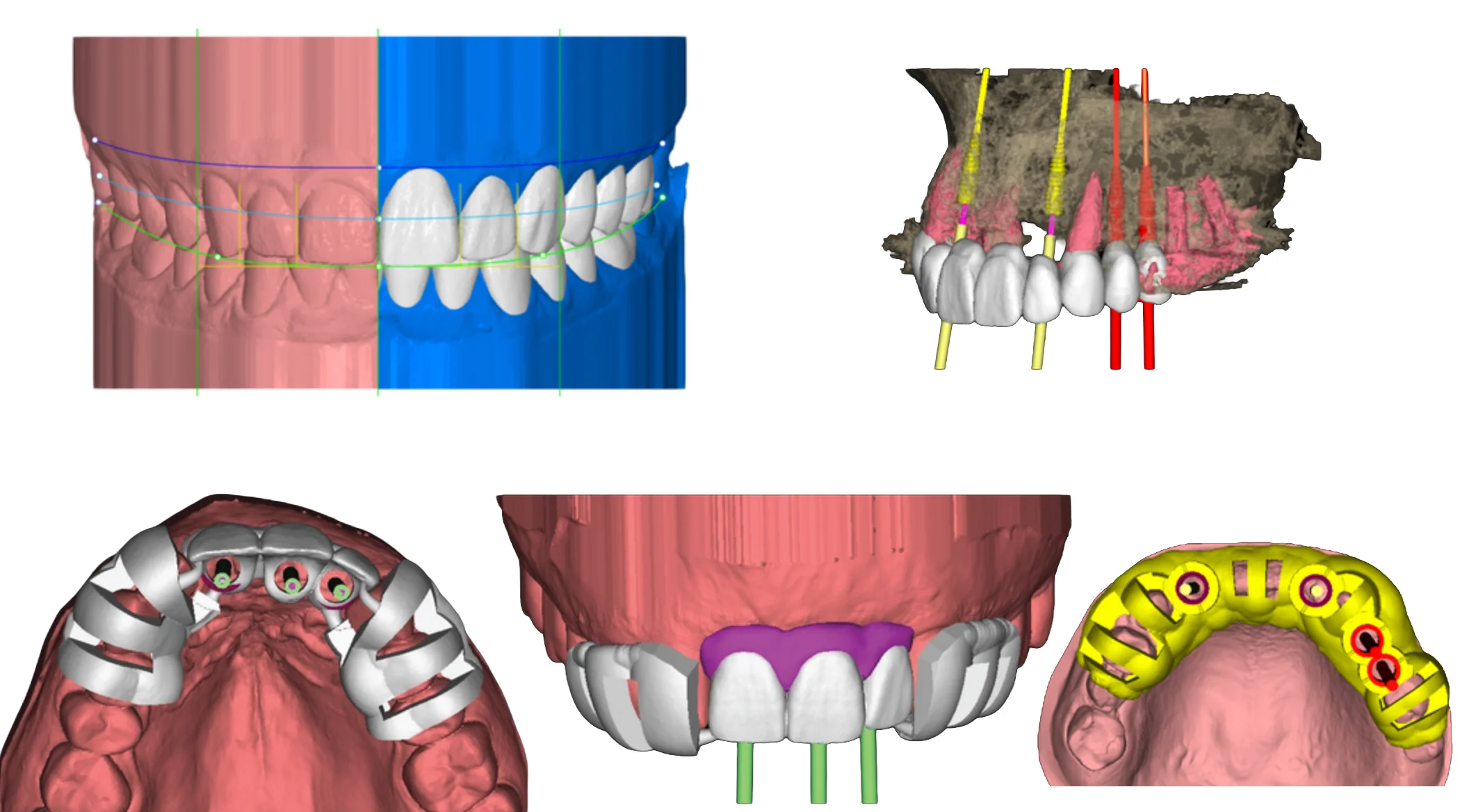 Designing and manufacturing surgical guides based on the patient's smile.